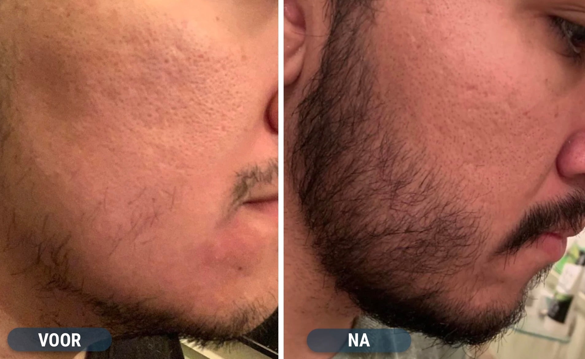 Minoxidil Baard resultaten
